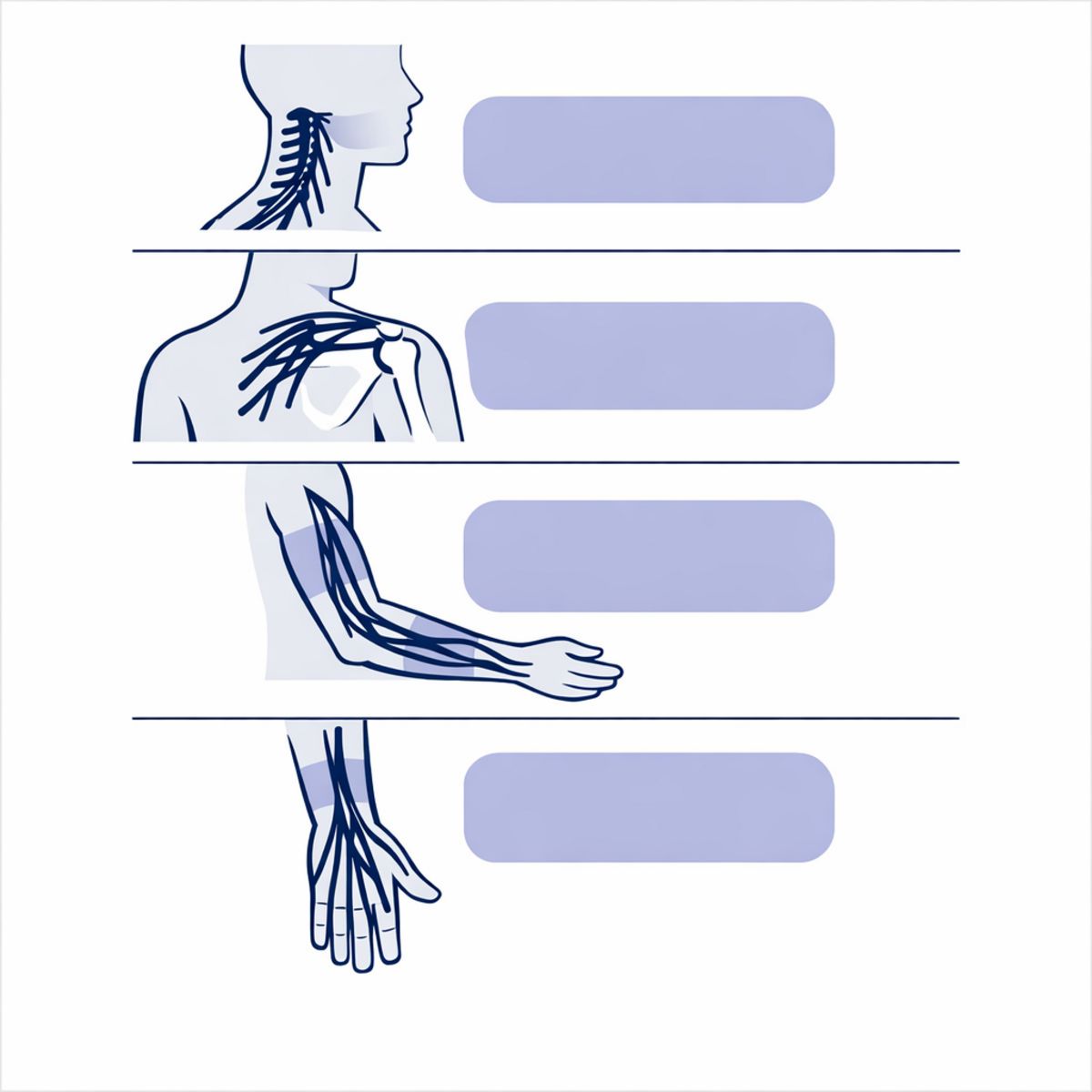 Infographic showing brachial plexus nerve pathway from neck to hand with symptom zones highlighted.