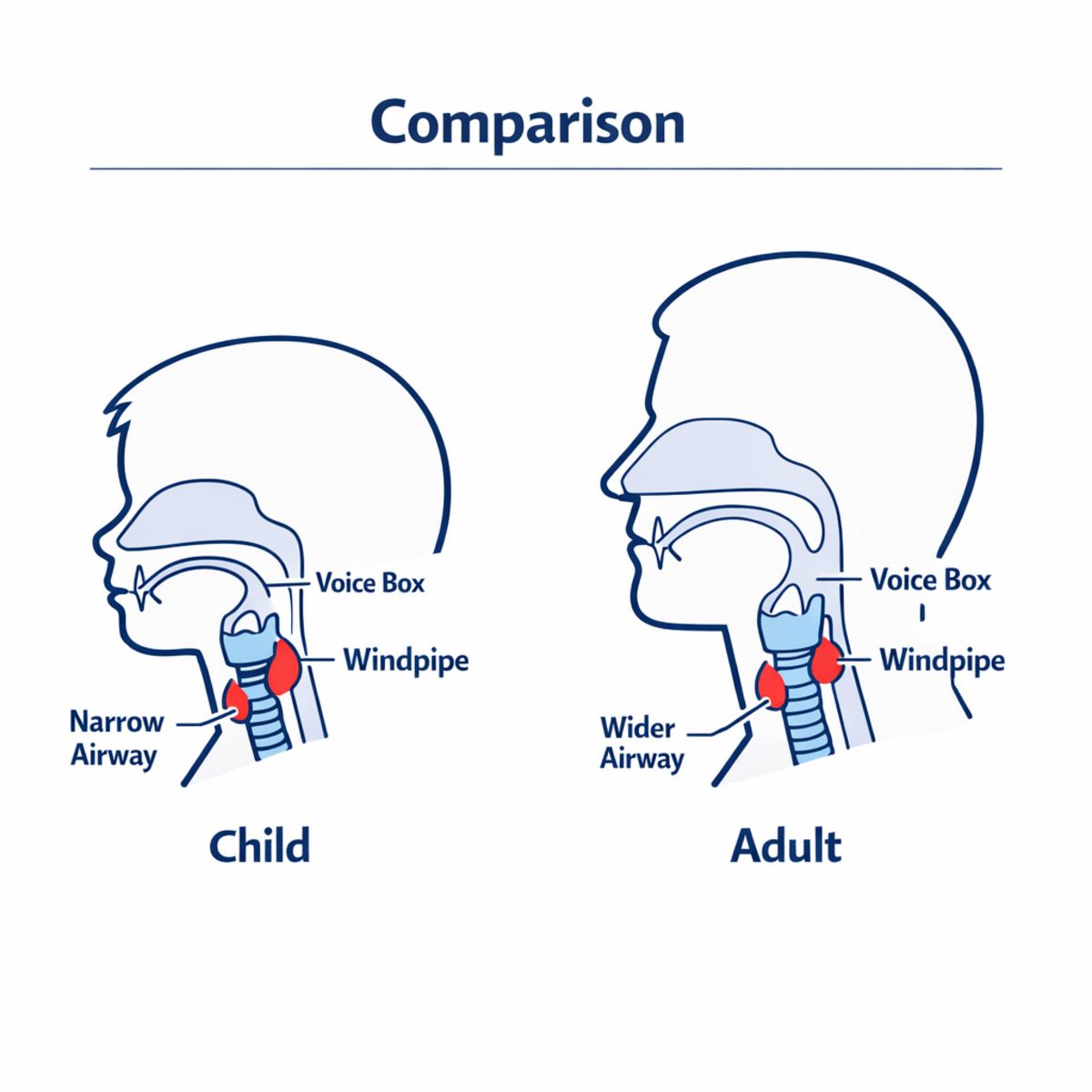 Infographic comparing child and adult upper airways, showing swelling impact on airway size.